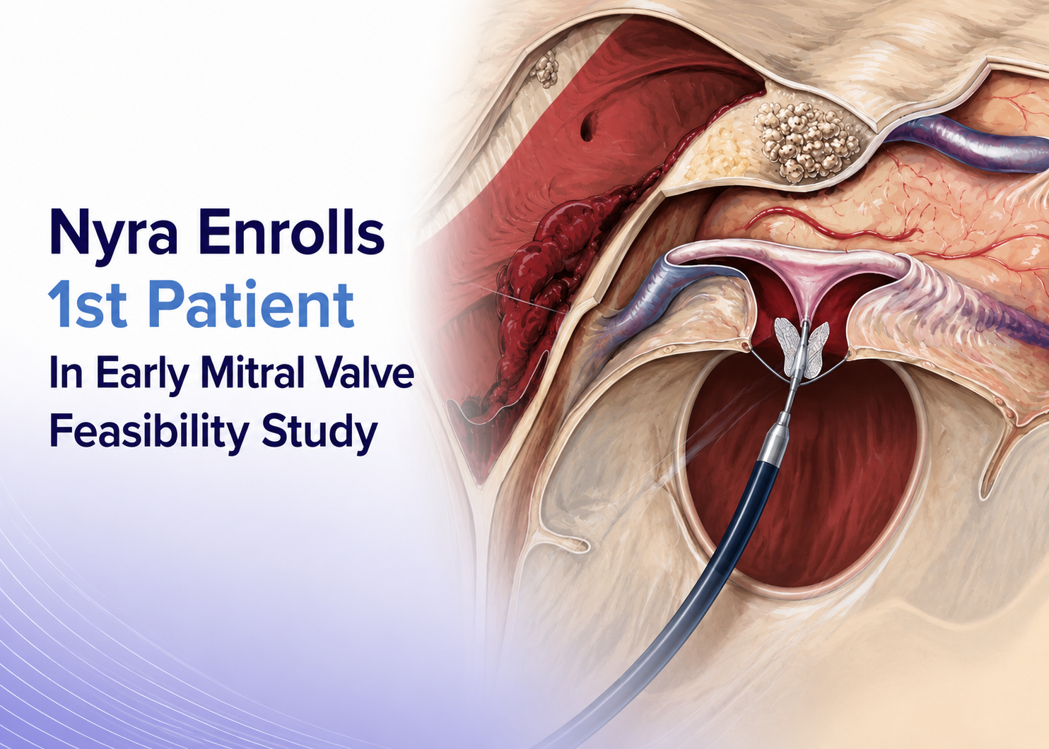 Nyra Enrolls 1st Patient In Early Mitral Valve Feasibility Study