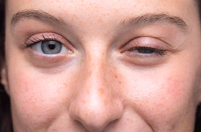 Ocular Myasthenia Gravis Gets Its First Targeted Biologic Candidate